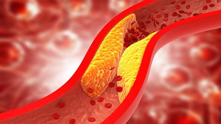 9 عادات صباحية تخفض مستويات الكوليسترول في الدم خلال شهر